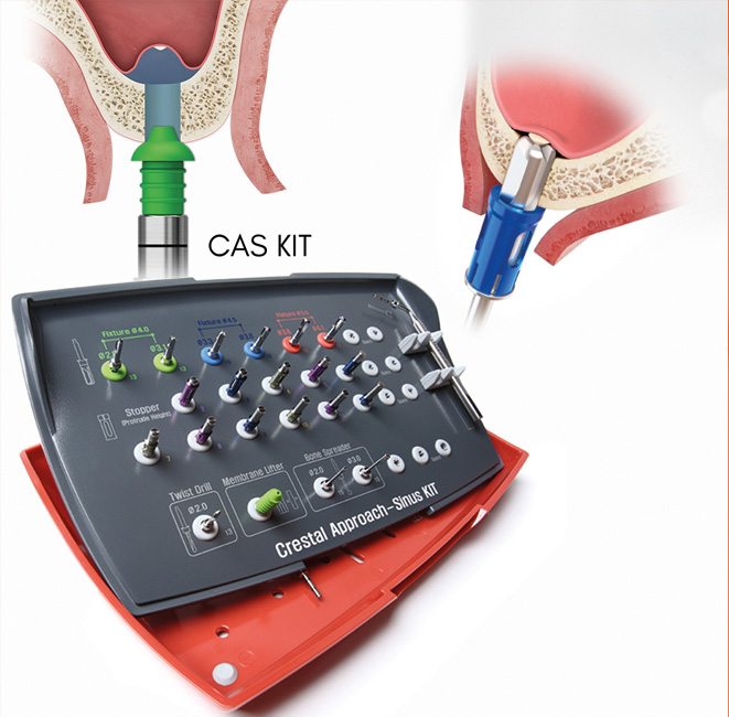 Curettes pour sinus