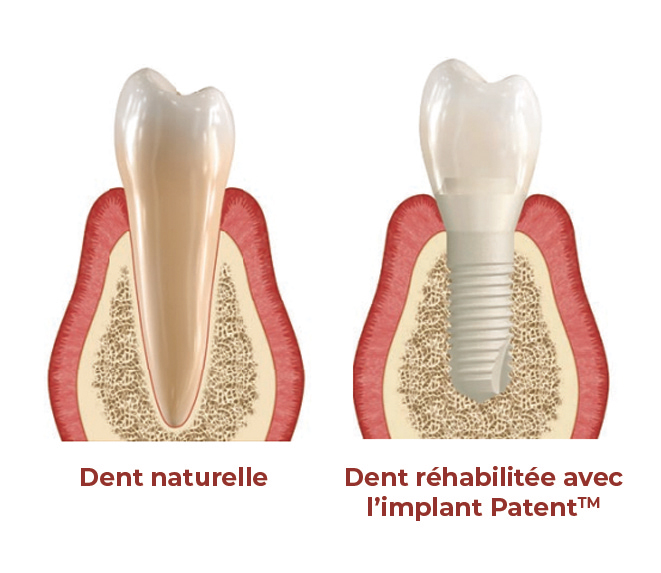 Implants