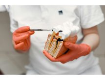 Caries dentaires : vers le remboursement de quatre nouveaux actes conservateurs