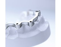 Barre sur implants