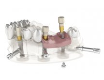 Composants prothétiques pour prothèse mobile