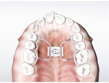 écarteur orthodontique