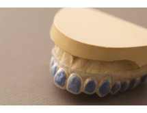 Gouttière pour blanchiment