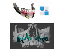 Implants