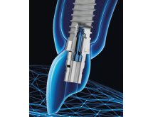 Implants
