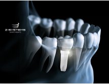 Implants
