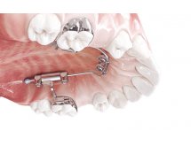 Mini-vis orthodontique