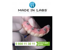 Prothèse sur implant