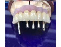 Prothèse sur implant