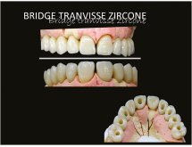 Prothèse sur implant