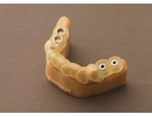 Prothèse sur implant