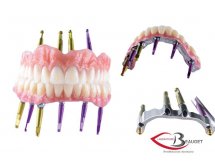 Prothèse sur implant