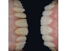 Prothèse sur implant