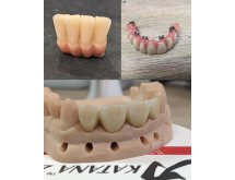 Prothèse sur implant