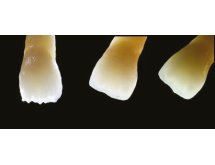 Prothèse zircone