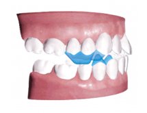 Système d'évaluation d'occlusion