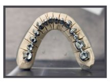 Prothèse Cobalt-Chrome