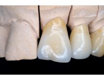 Prothèse céramo-céramique