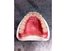 Prothèse partielle acrylique adjointe