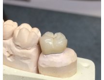 Prothèse conjointe composite