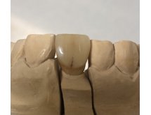 Prothèse sur implant