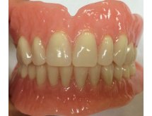 Prothèse complète adjointe