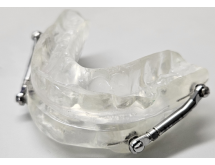 Gouttière anti-ronflement