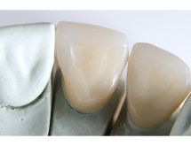Prothèse céramo-céramique