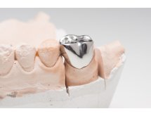 Prothèse Cobalt-Chrome