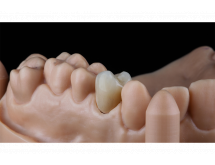 Prothèse conjointe composite