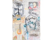 Prothèse partielle métallique adjointe avec attachement