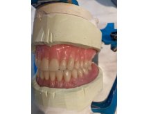 Prothèse complète adjointe