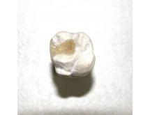 Inlay / Onlay