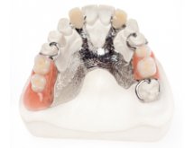 Prothèse combinée