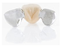 Prothèse conjointe collée