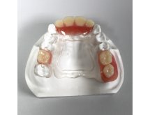 Prothèse partielle acrylique adjointe