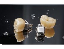 Prothèse sur implant