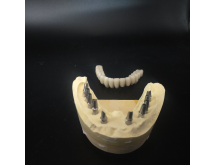 Prothèse sur implant