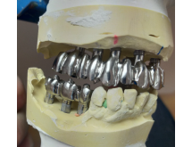 Prothèse Cobalt-Chrome