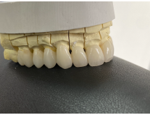 Prothèse céramo-céramique