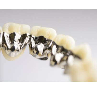 Alliages métaux non précieux