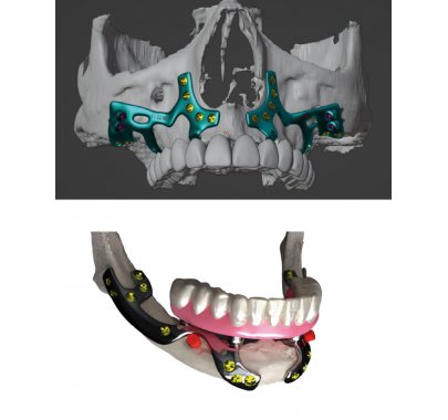 Chirurgie maxillo-faciale (fournitures pour)