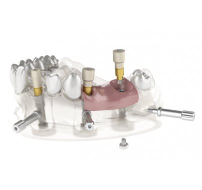 Composants prothétiques pour prothèse fixée