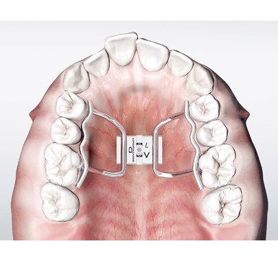 écarteur orthodontique