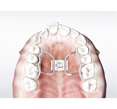 écarteur orthodontique