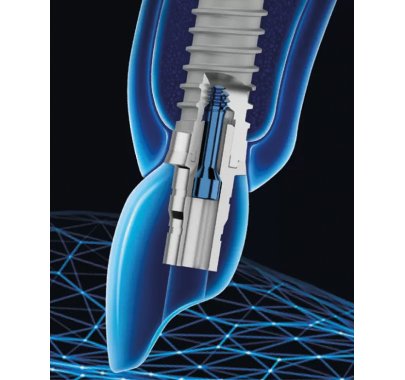 Implants