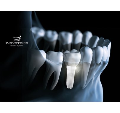 Implants