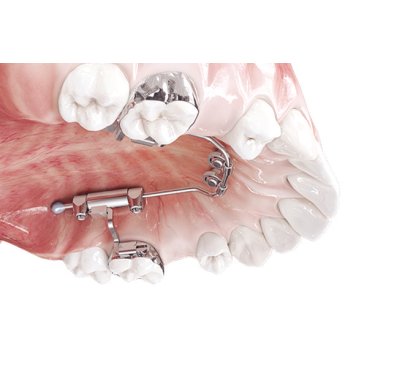 Expo dentaire - Mini-vis orthodontique