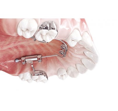 Mini-vis orthodontique