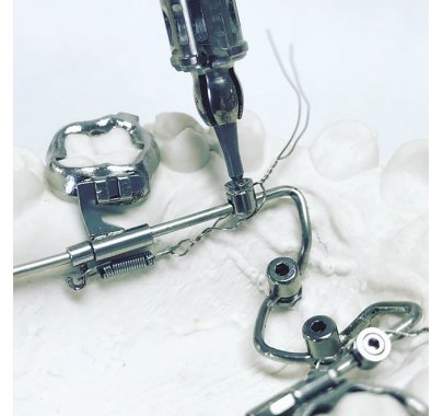 Mini-vis orthodontique